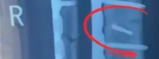 手术室惊魂：同一病房两人体内被“遗忘”钻头，医院竟称“影响不大”隐瞒数月！